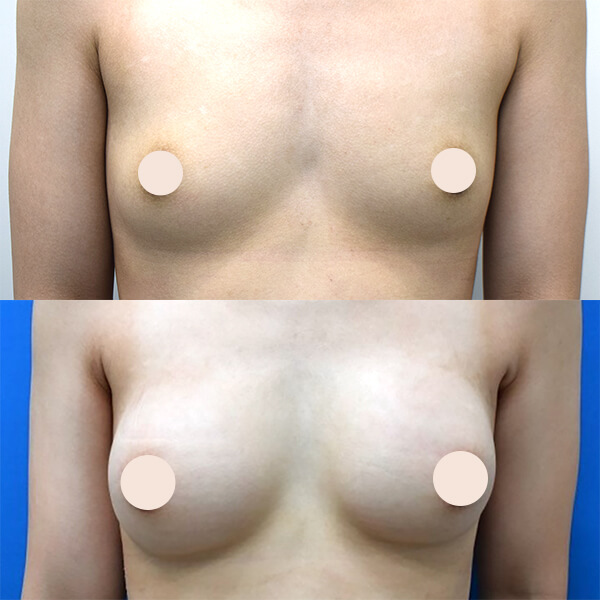 シリコンインプラント豊胸術 症例-01