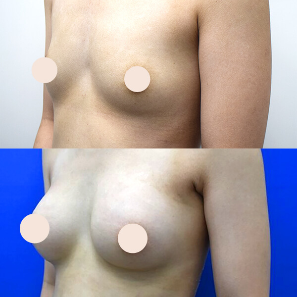 シリコンインプラント豊胸術 症例-02