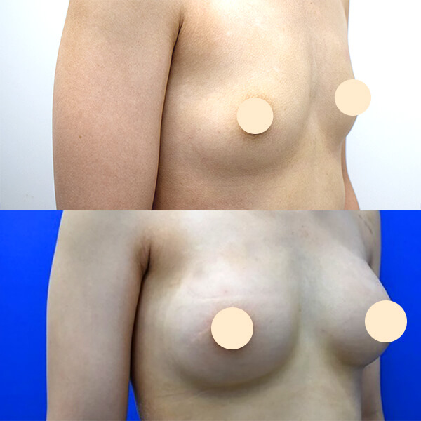 シリコンインプラント豊胸術 症例-03